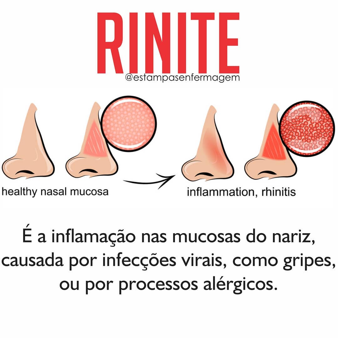 Estampas Enfermagem - A rinite é a inflamação nas mucosas do nariz ...