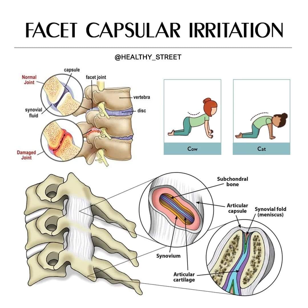 Healthy - 🔈 FACET CPSULAR IRRITATION Lumbar facet syndrome refers to a ...