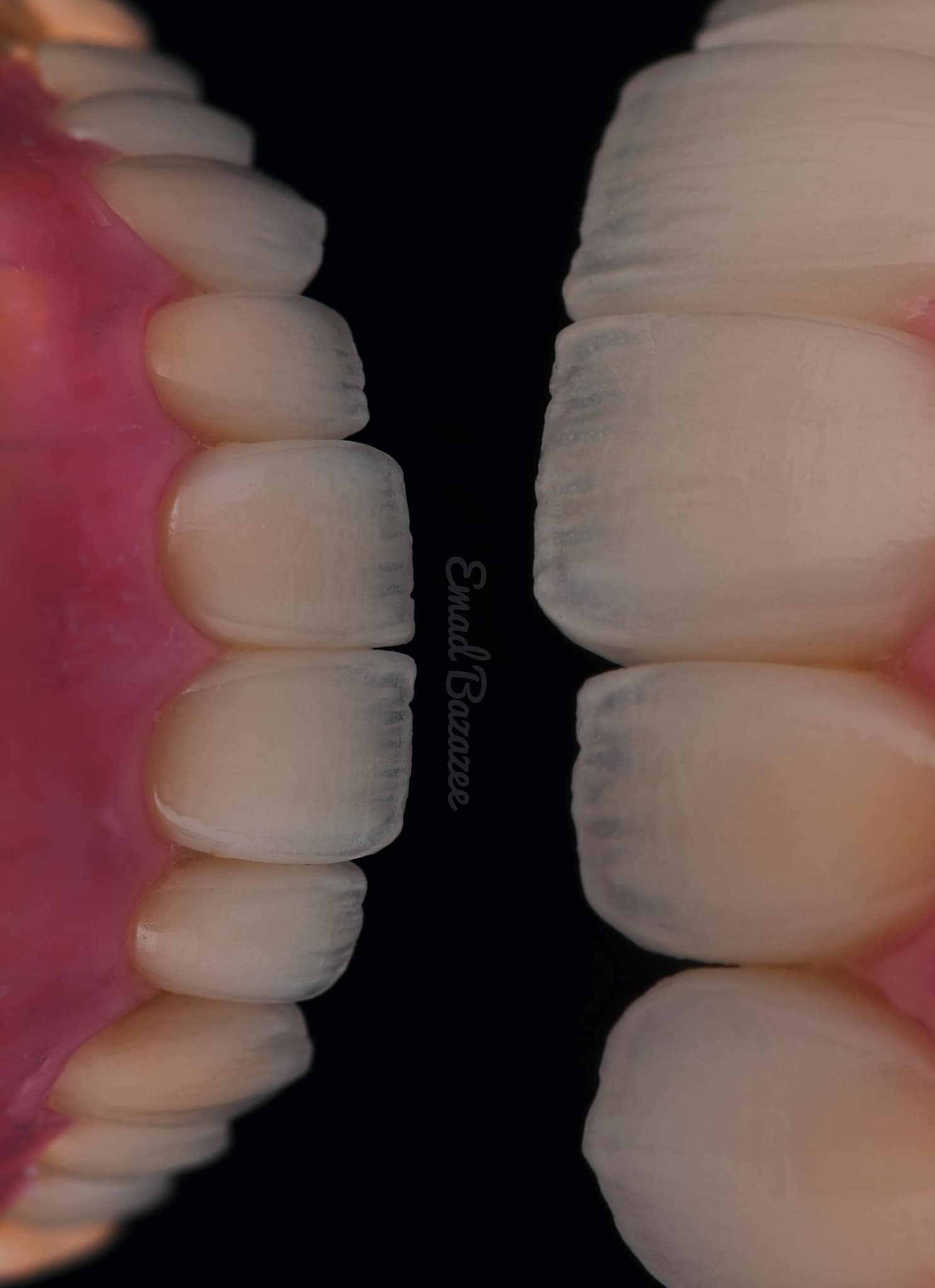 Anteriores | Dark color on #emax veneers | Facebook