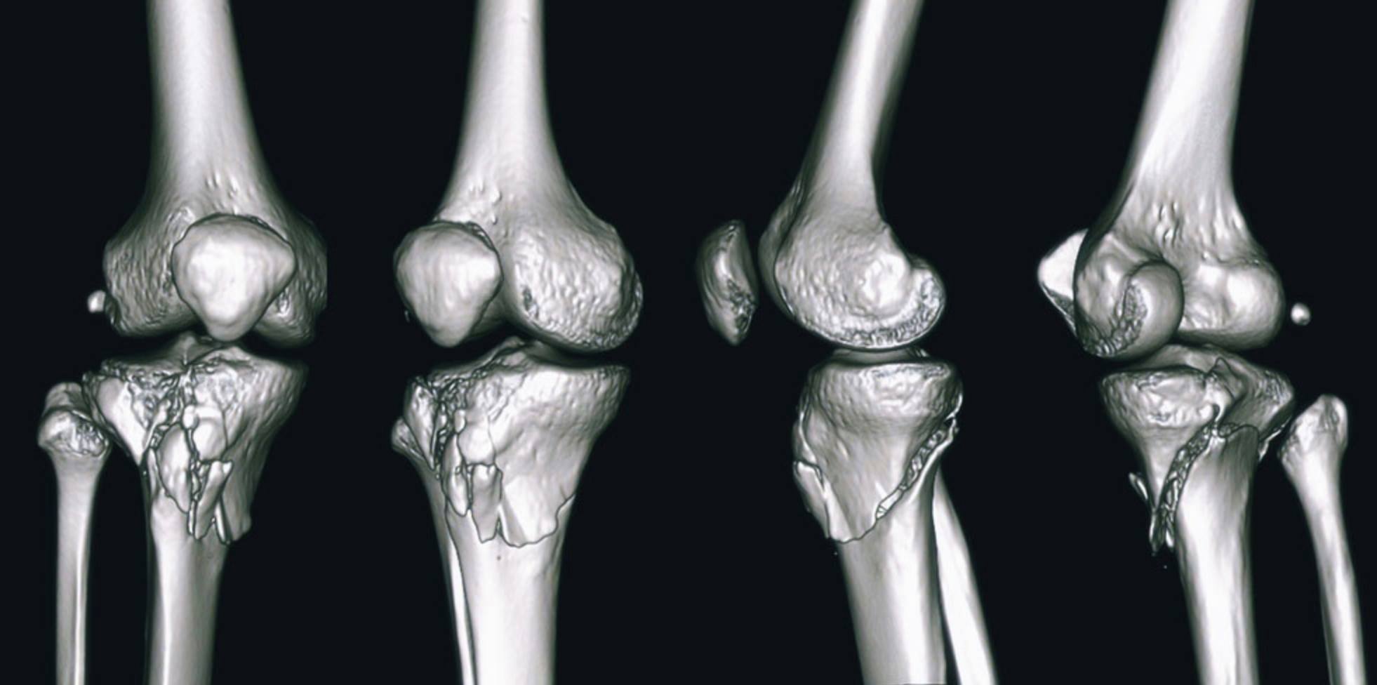Robert F. LaPrade, MD, PhD - Knee Surgeon & Sports Medicine Specialist ...