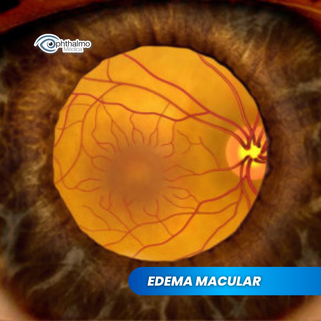 El edema macular es la... - Ophthalmo Medica Ensenada