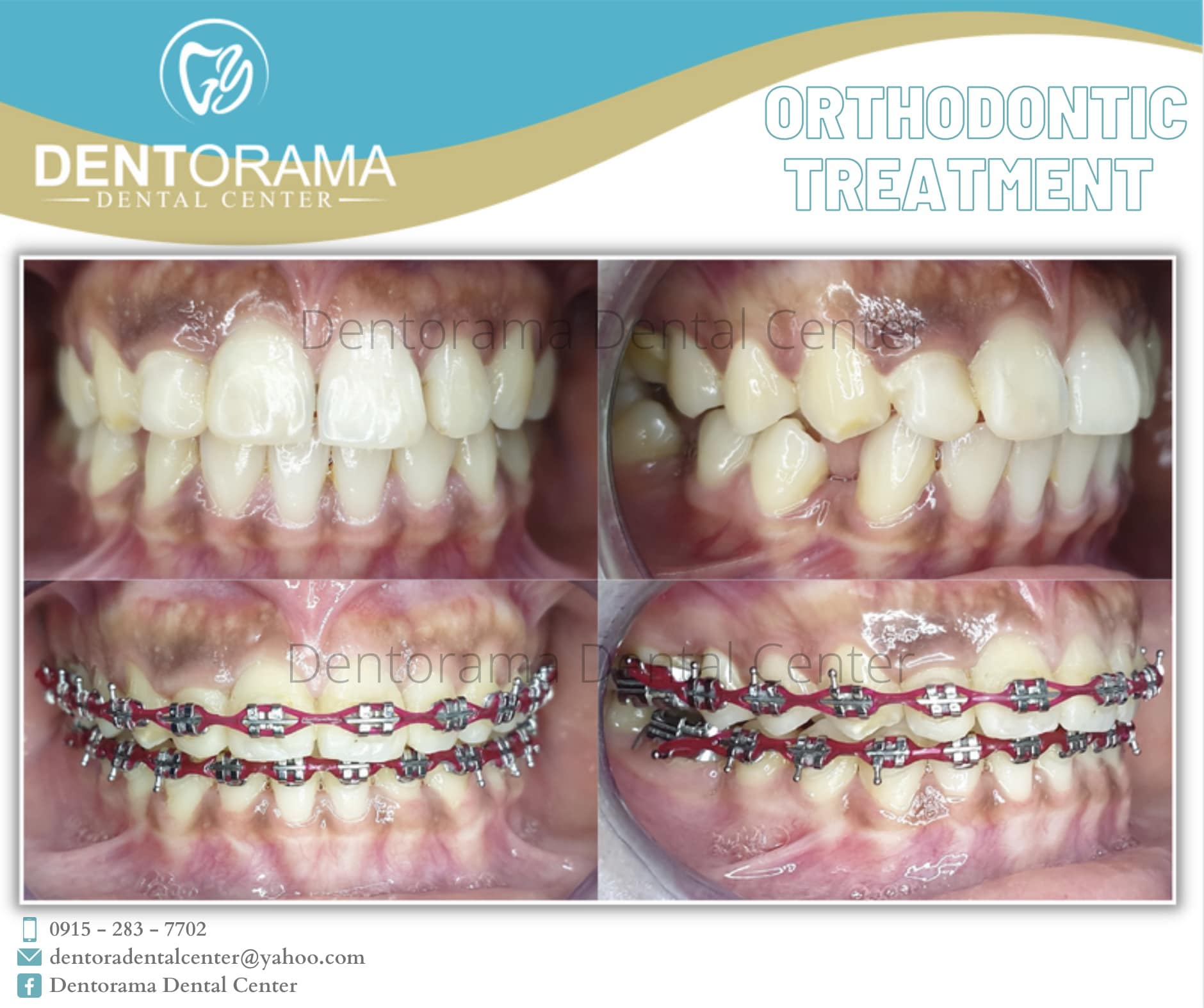 Progress of a case... - Dentorama Dental Center - Calapan | Facebook