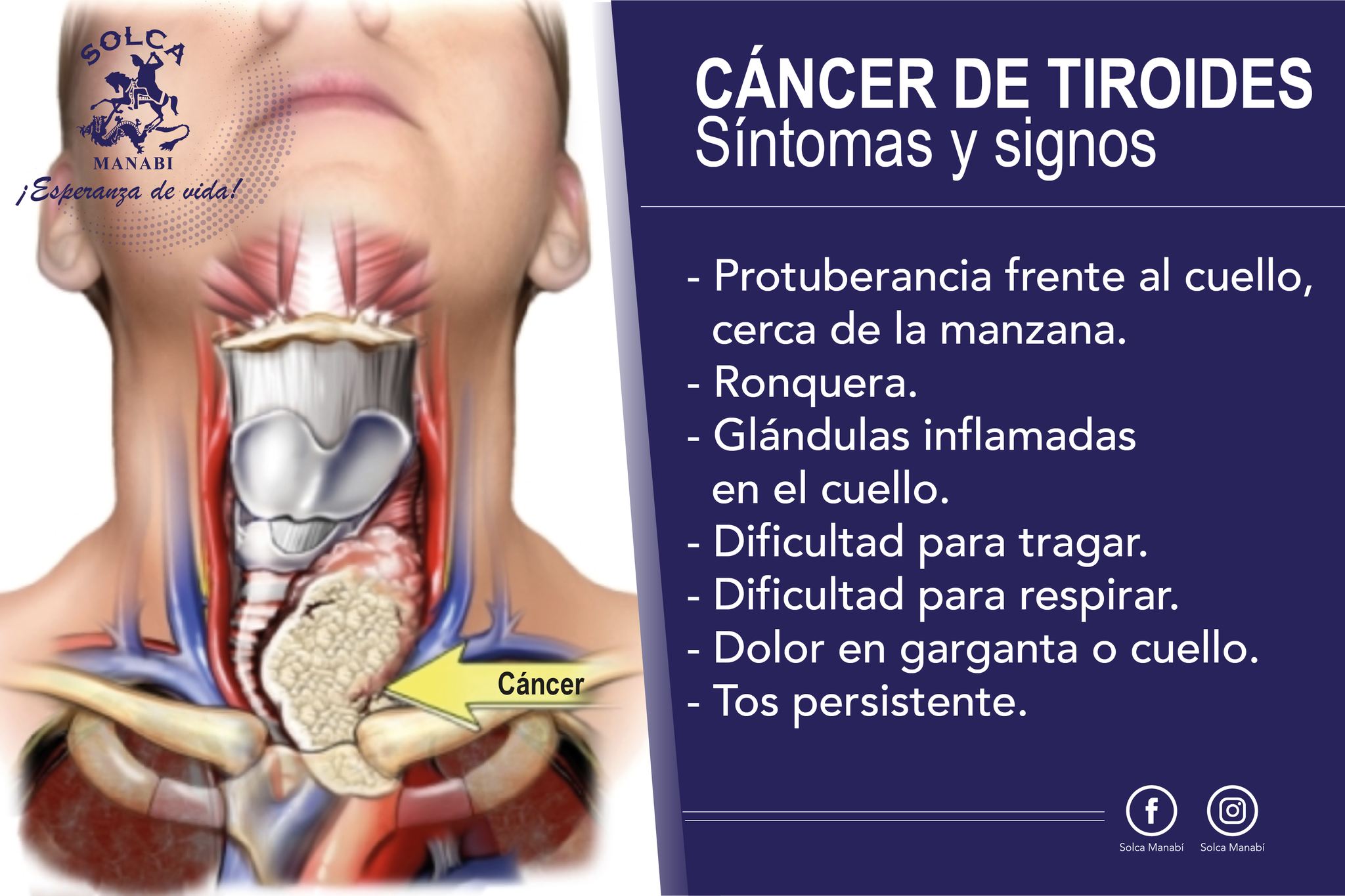 SOLCA - Cáncer de tiroides: Síntomas y signos Es frecuente que las ...