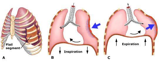MedicTests.com - A flail chest occurs when two or more ribs are ...