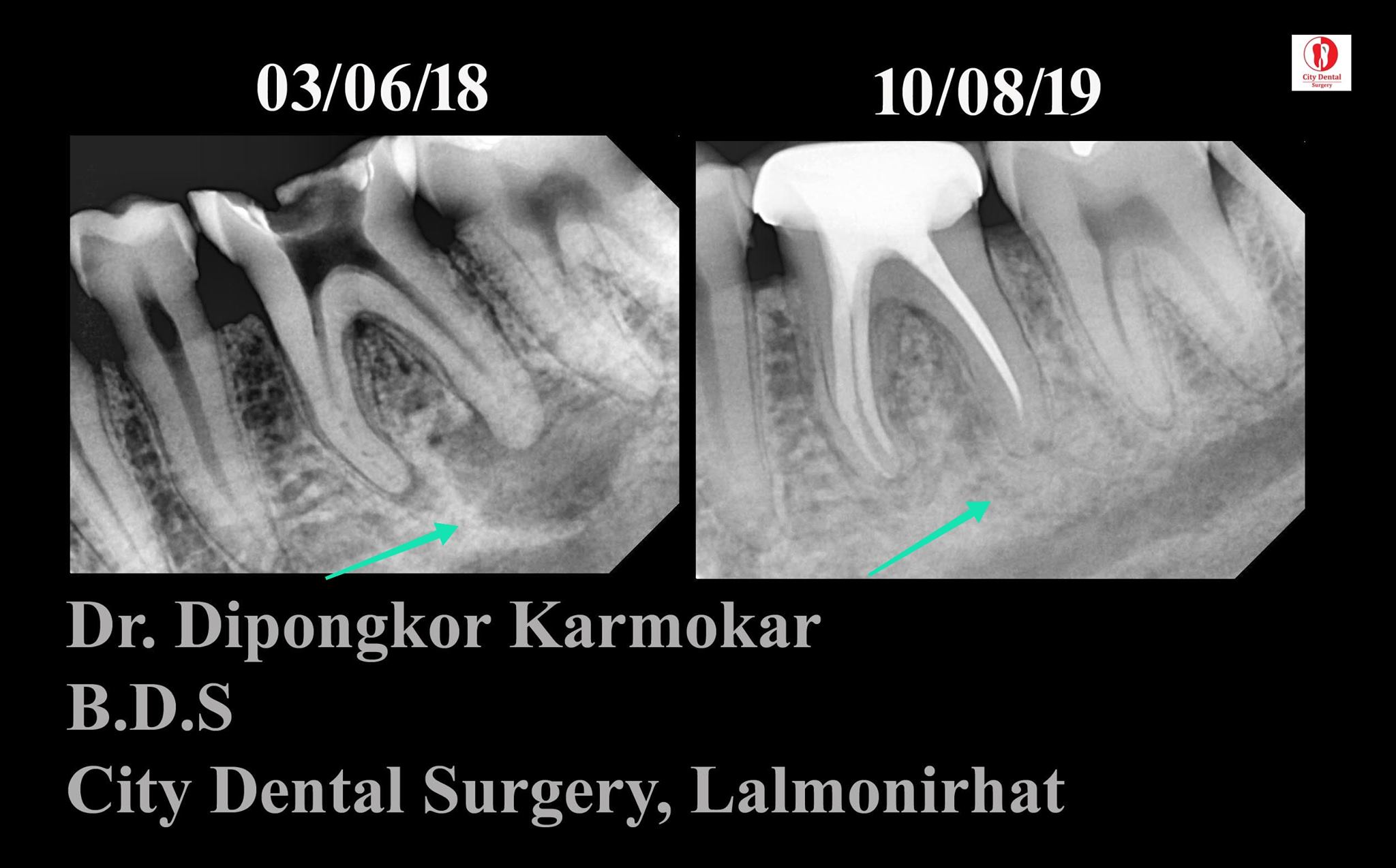 What happens if a RCT... - সিটি ডেন্টাল সার্জারি, লালমনিরহাট