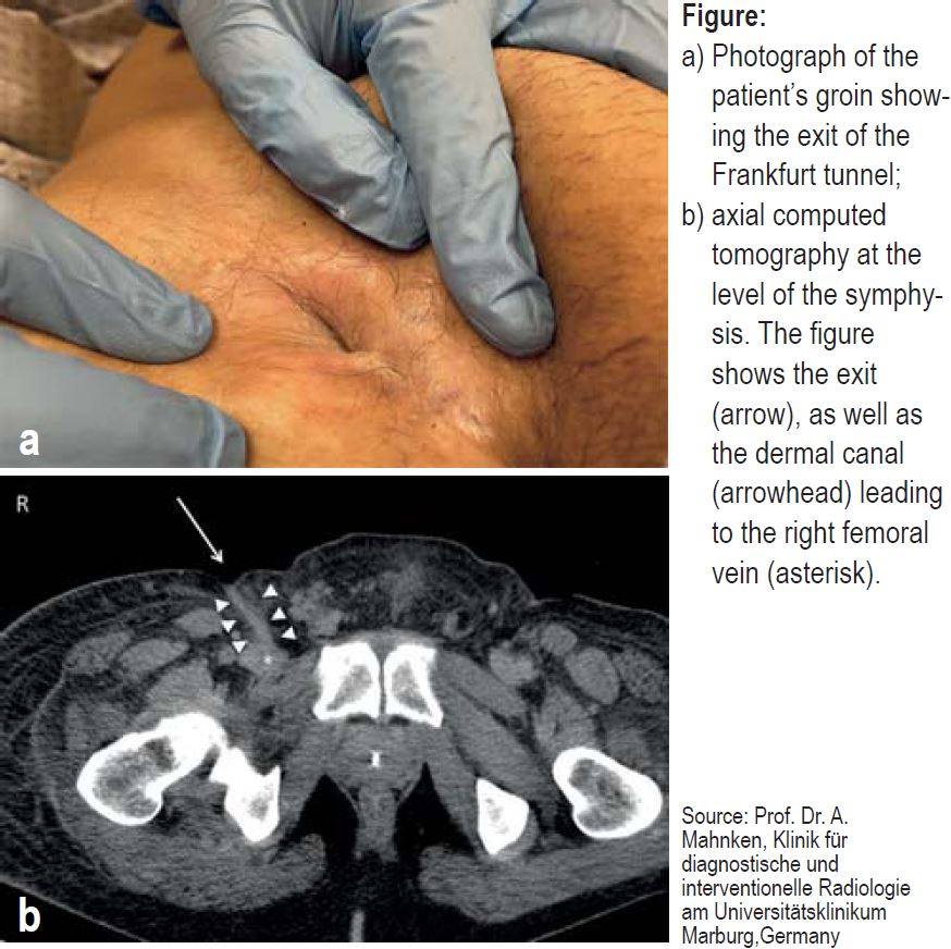 Caduceus EM & Critical Care FOAM | 🩺Factitious Intravenous Drug ...