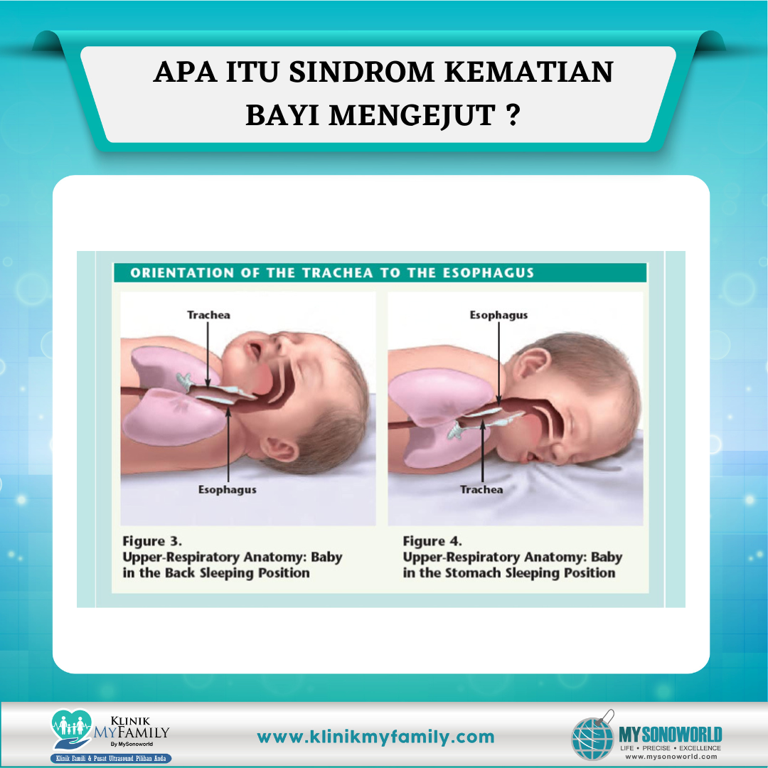 Sindrom Kematian Bayi... - Klinik MyFamily By Mysonoworld
