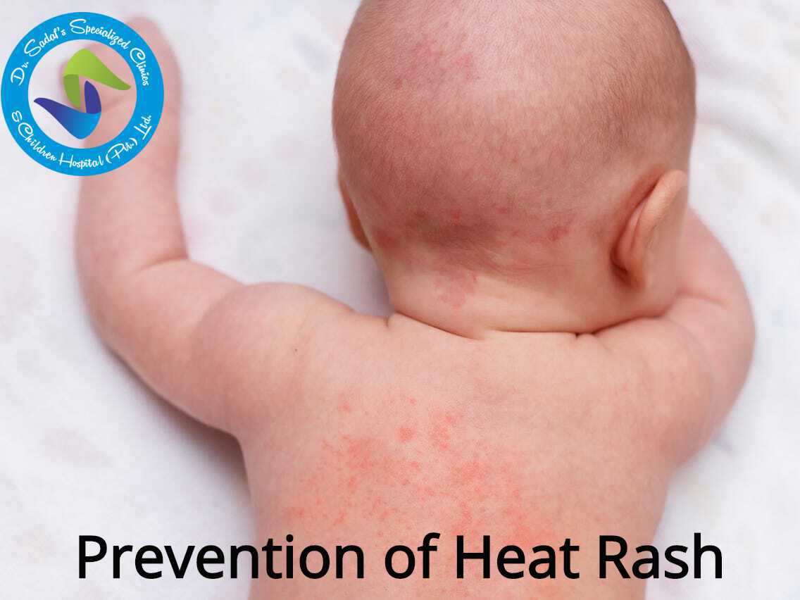 Dr. Sadaf's Specialized Hospital - Heat rash — also known as prickly ...