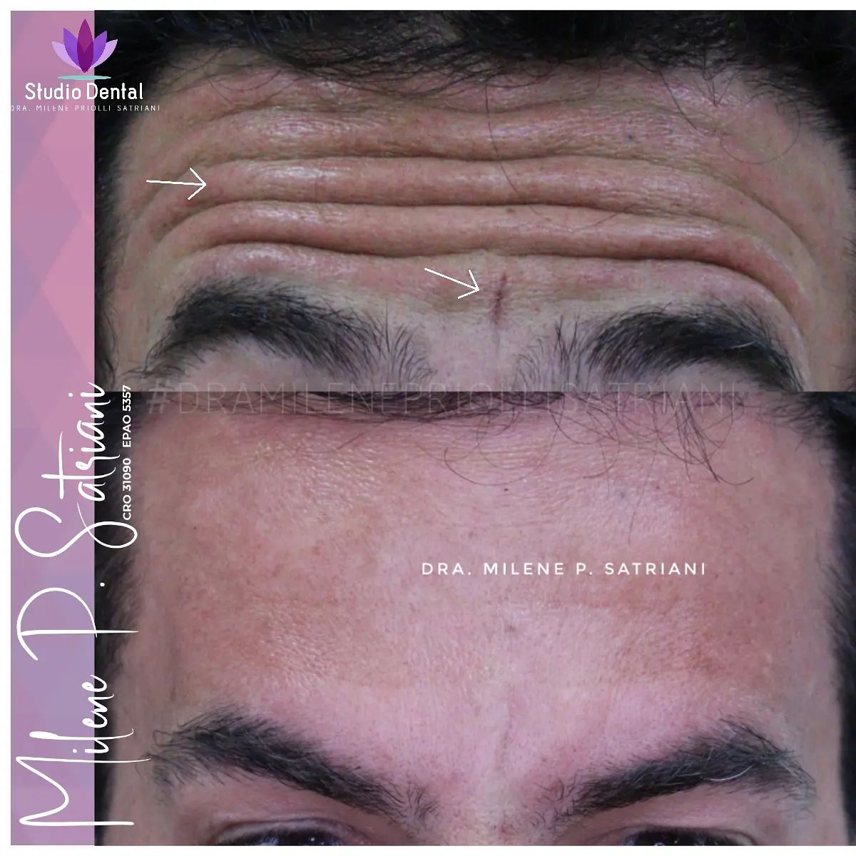 ⚜ Botox + tratamento da ruga... - Studio Dental Pouso Alegre