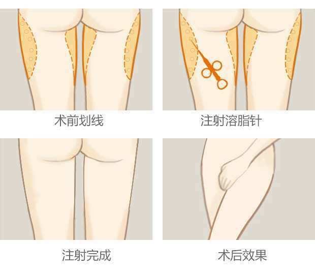 V Beauty 薇の整工作坊 溶脂针瘦大腿推荐指数 Facebook