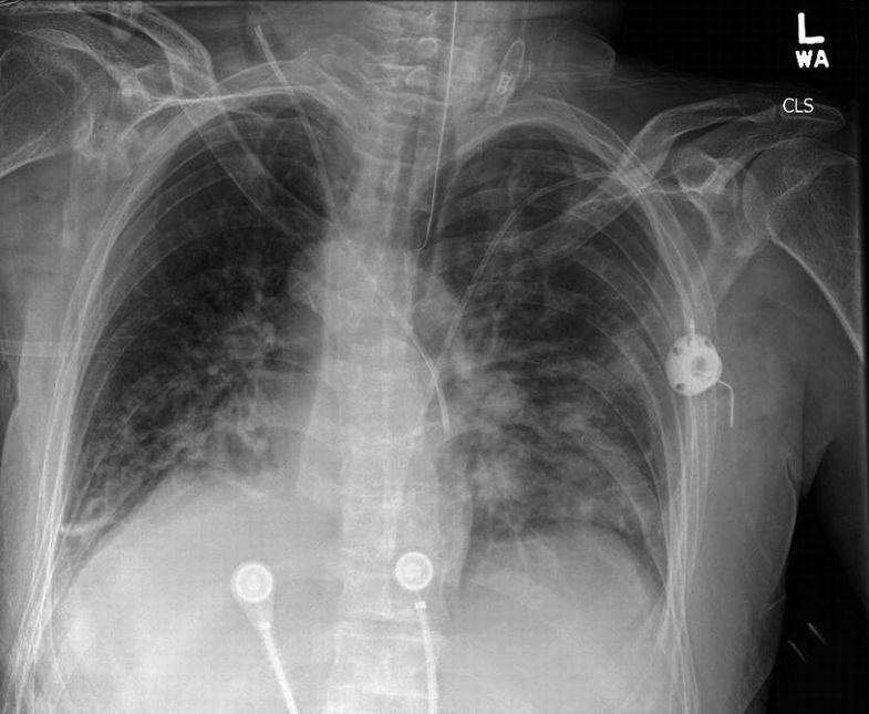 Persistent Left Superior Vena Cava... - Cardiology and CCU | Facebook