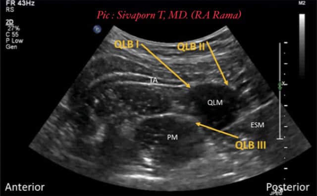 QL Block !!! QL block... - Regional Anesthesia RAMA - RA Rama | Facebook