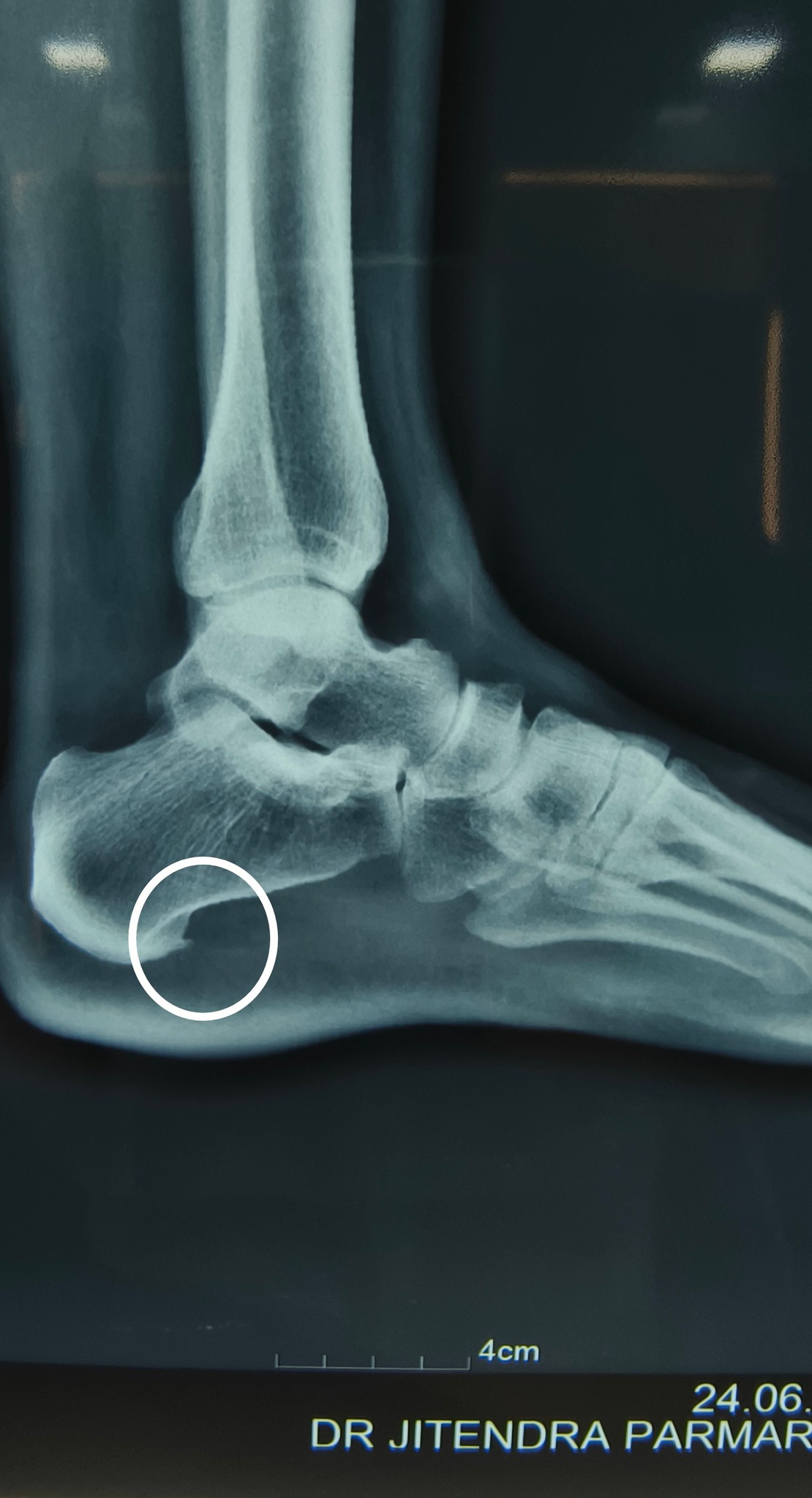 study b12 injection bone spur What is the best treatment for heel spurs? Best Medspa for Vitamin Size:1000 mcg/ml - 10 ml x 2 vitamin b 12 injectable
