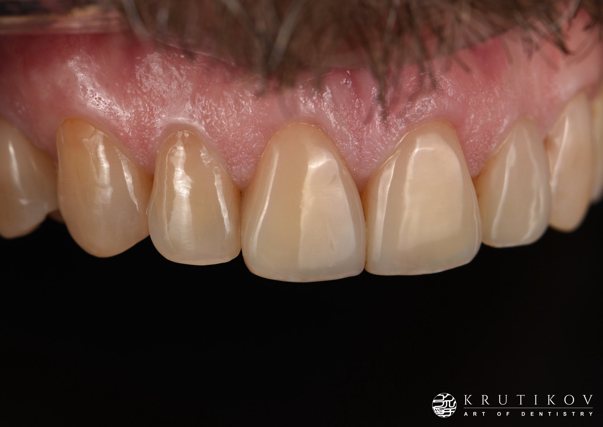Achieving white and pink esthetics in restorative dentistry