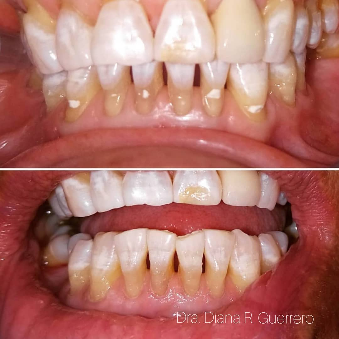 Periodoncia - Diana Rebeca Guerrero - 🔸Obturación de lesiones ...