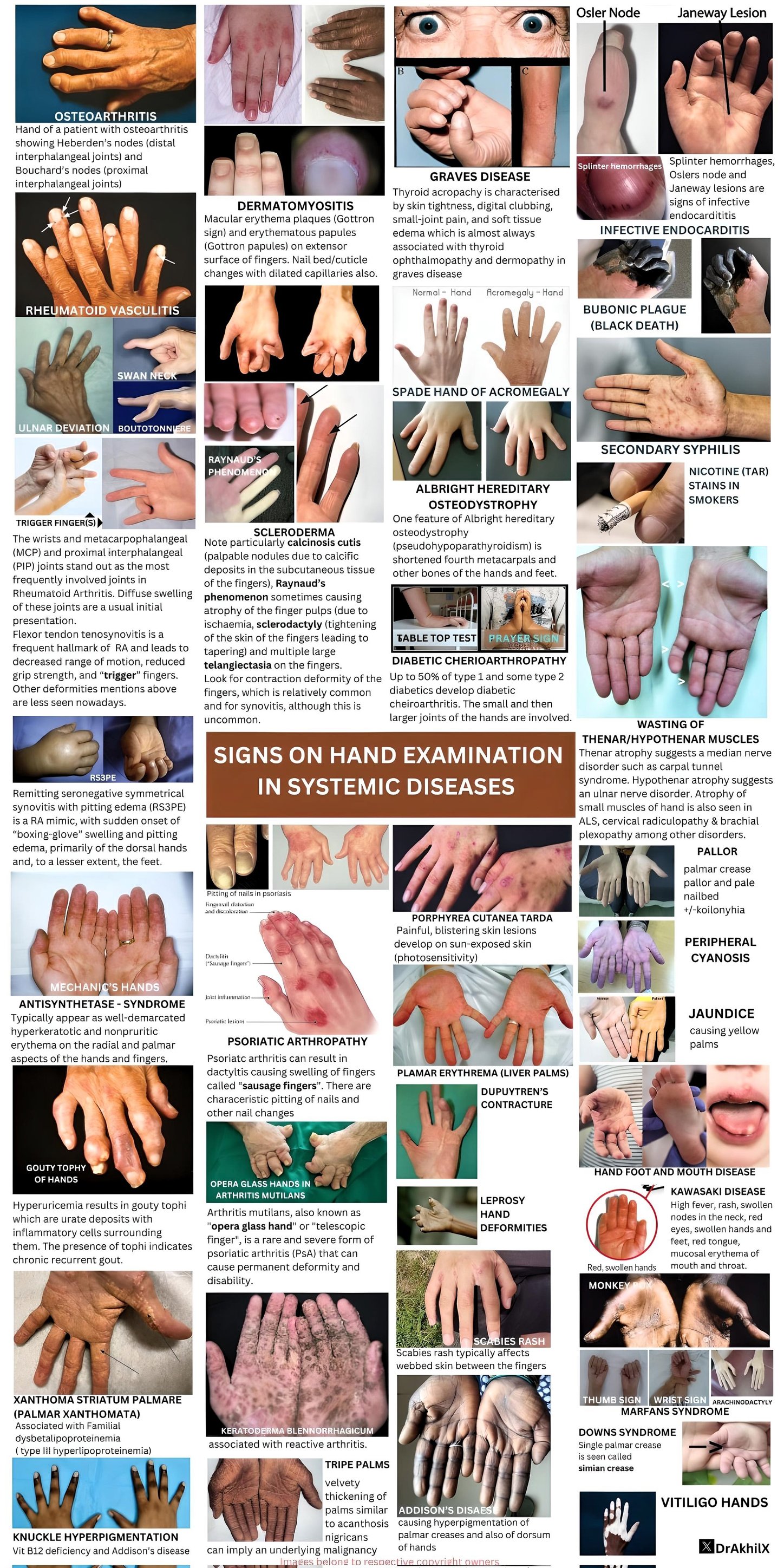 Caduceus EM & Critical Care FOAM | 🗝️Sign on hand exam in systemic ...