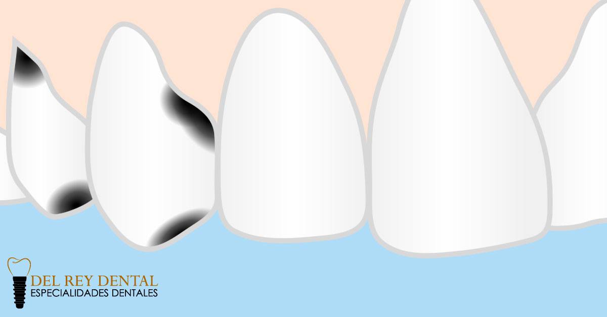 Del Rey Dental - ¿Qué es la caries? Te damos a conocer...