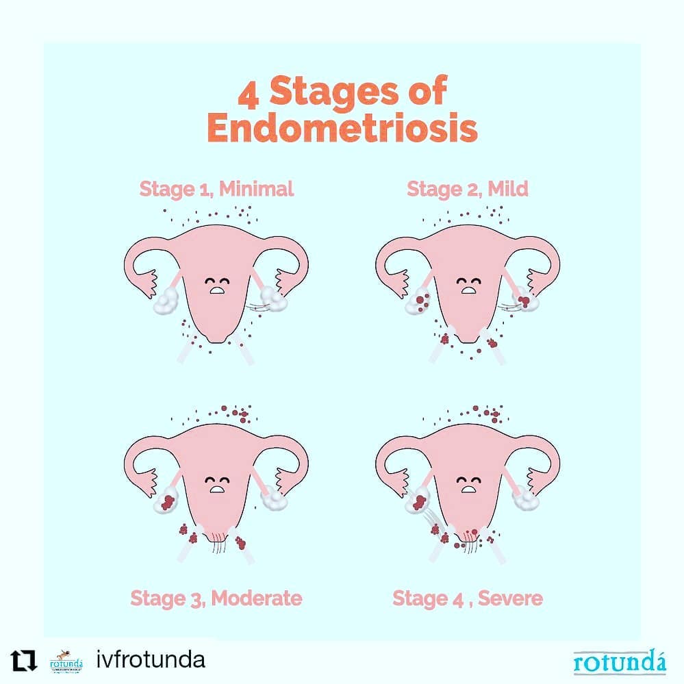 Dr.Akanksha Allahbadia Gupta - 👩‍⚕️Stages of endometriosis are decided ...