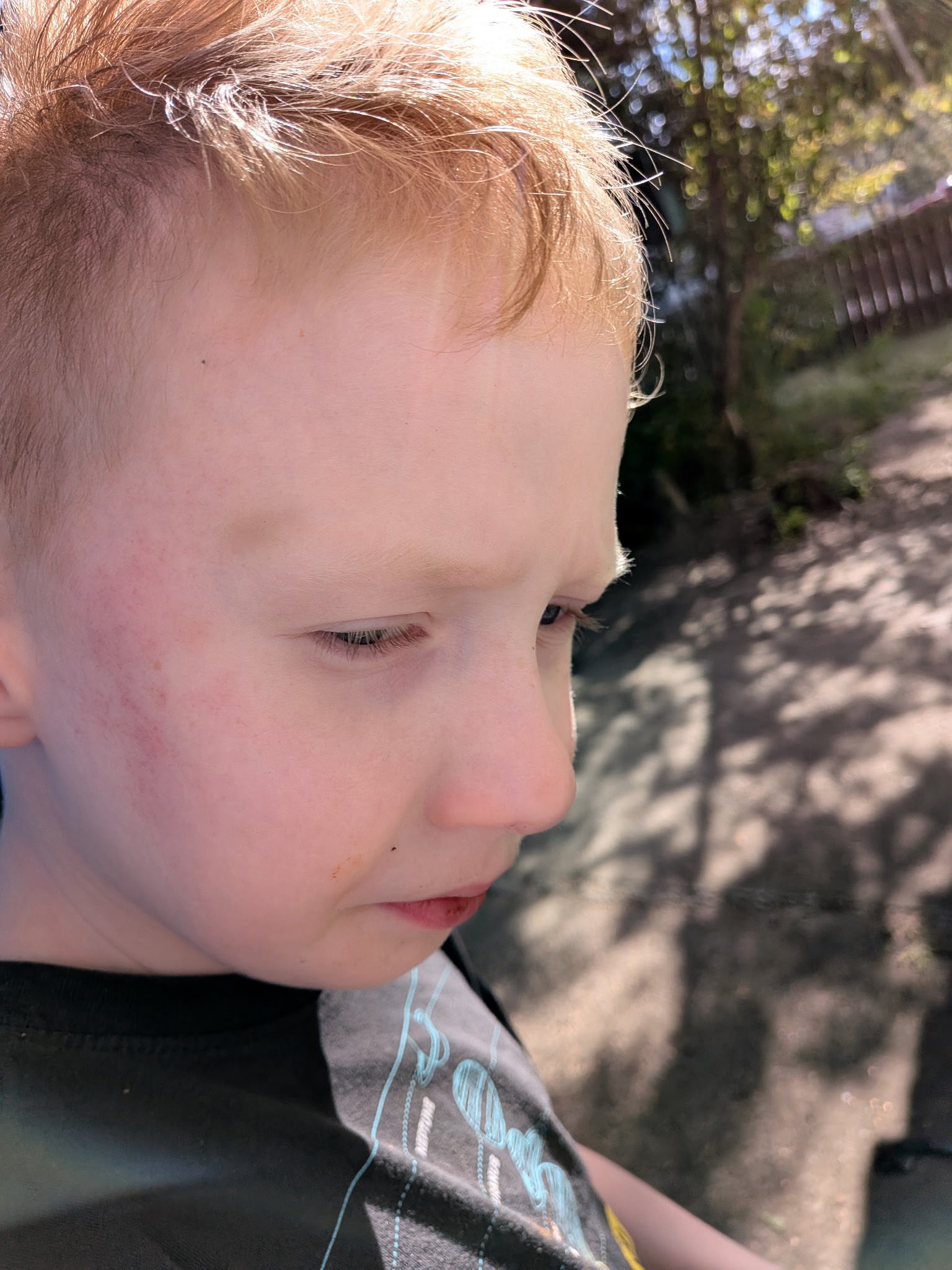 My nonverbal child, age 4, came home from school with a bruise