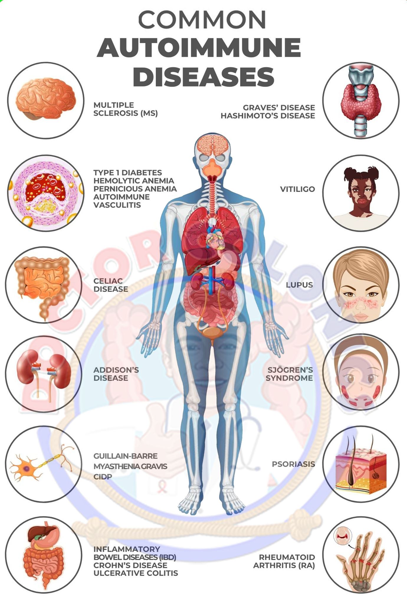 Eleazar - Autoimmune diseases occur when the immune system mistakenly ...
