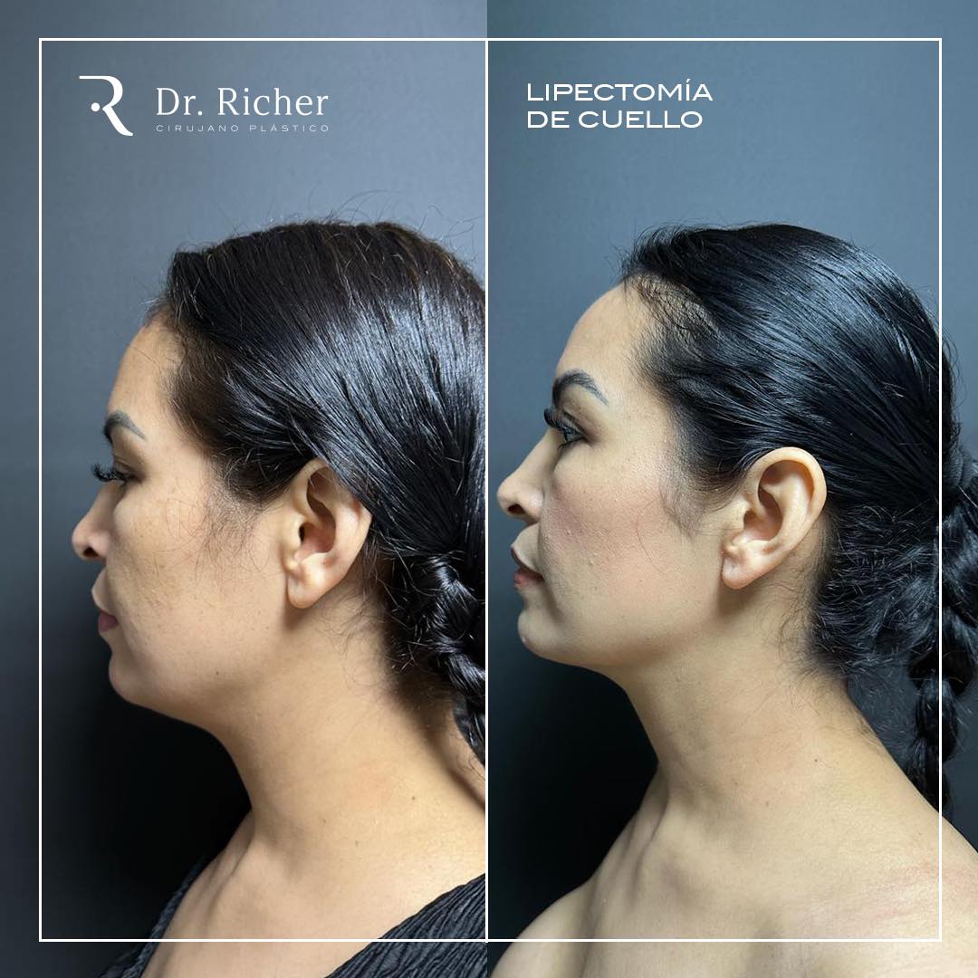 Dr. Richer Cirujano Plástico | San Pedro Garza Garcia