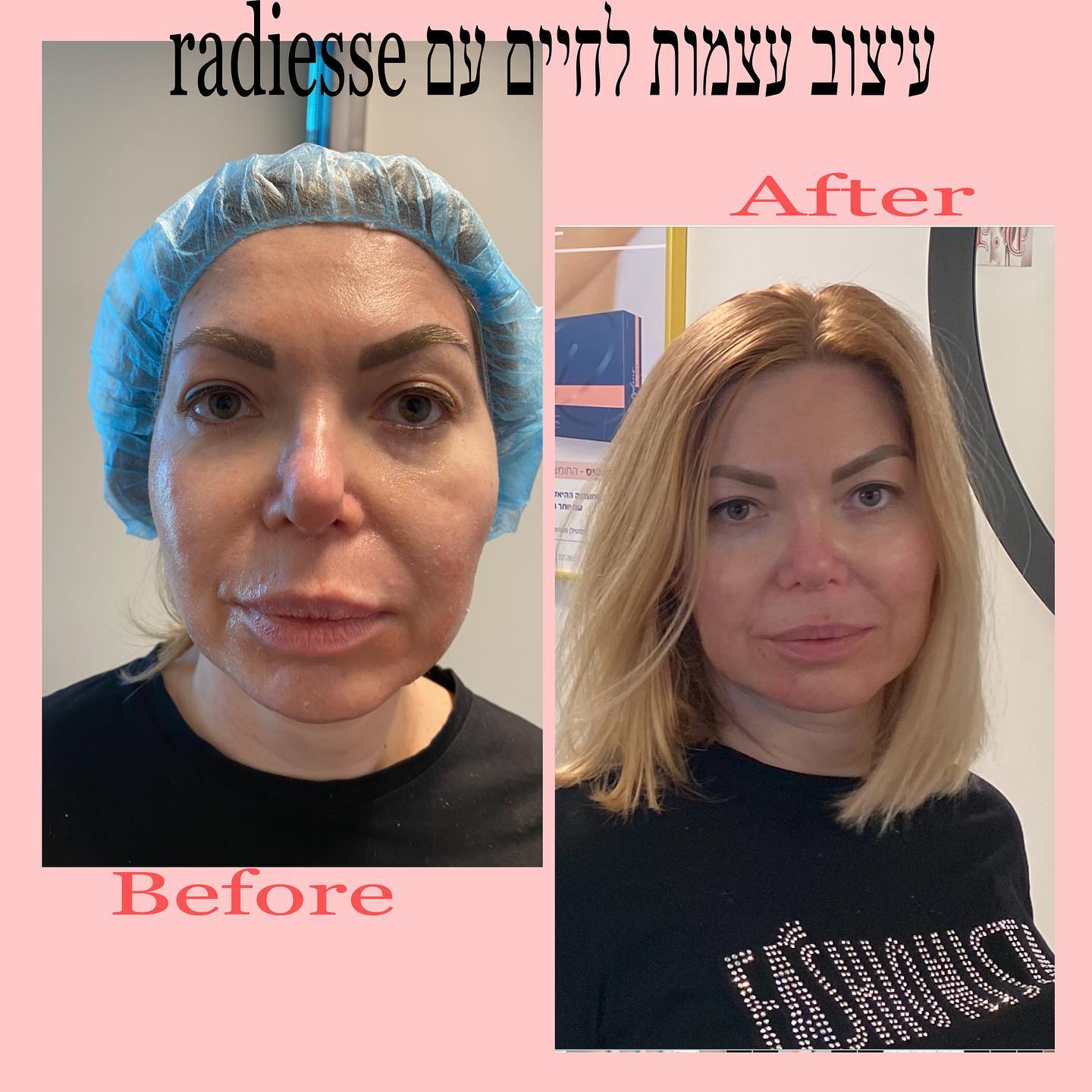 Dr.Begelman Lina - עיצוב עצמות לחיים בהזרקת Radiesse 😊 | Facebook