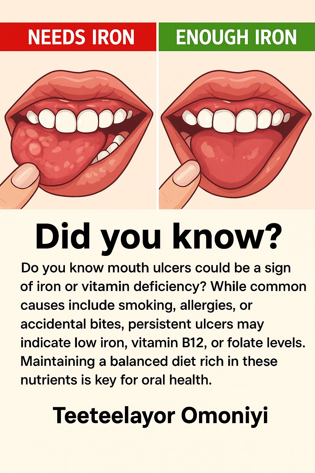 Don't ignore mouth ulcers or a burning tongue. It may be a sign of Vitamin B12 deficiency. Get checked by Dr. Vaishali Kataria at Sarvesh Health City. 📞 6901626262 #ENTSpecialist #HealthCheck #VitaminB12 #