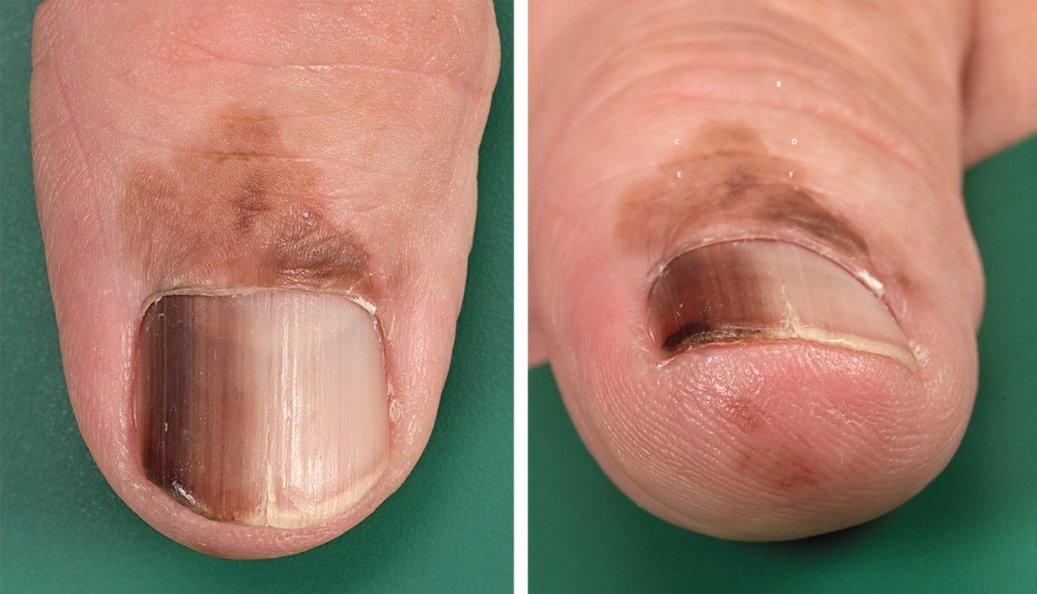 melanotic macule nail A 25-year-old presents with a longitudinal brown-black streak on the thumbnail. No trauma history. Examination reveals no periungual pigmentation.What diagnostic steps and management are recommended? NO_Block Kapseln:60 Kapseln Kozicare Kojic Acid Soap