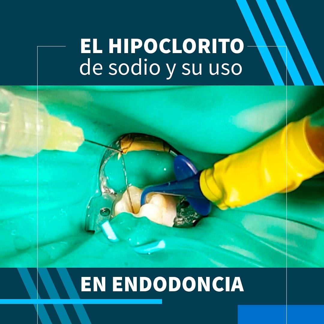 el-hipoclorito-de-sodio-lej-a-vias-de-la-pulpa-facebook