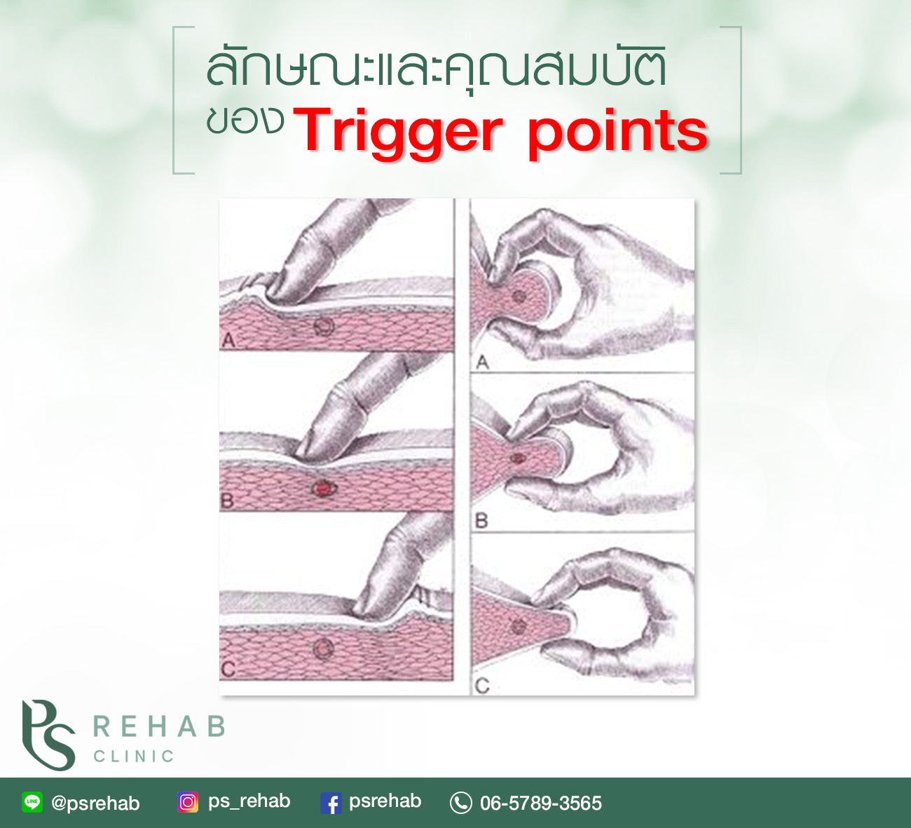 มาต่อเรื่อง Trigger Point กัน วันนี้เราจะลองสังเกตุ ภายนอกของ Trigger ...