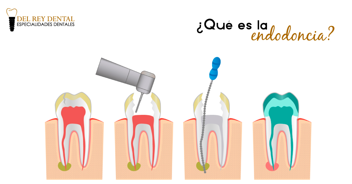 Del Rey Dental - La Endodoncia es también conocida como...