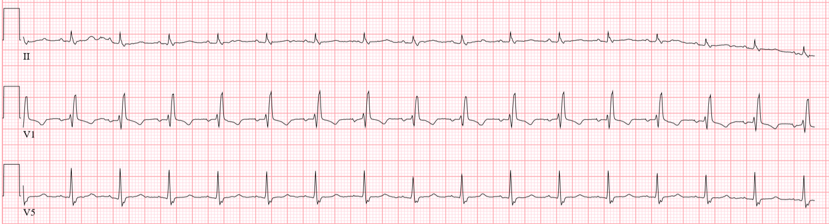 The EKG Guy - What is shown below? A. Normal sinus rhythm... | Facebook