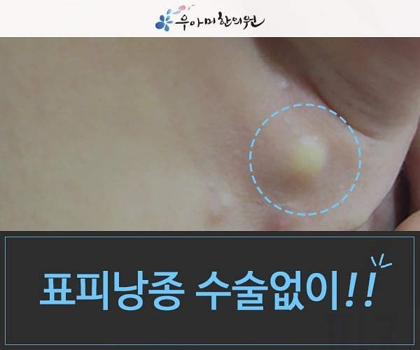 우아미한의원 - 표피낭종 압출로!... | Facebook
