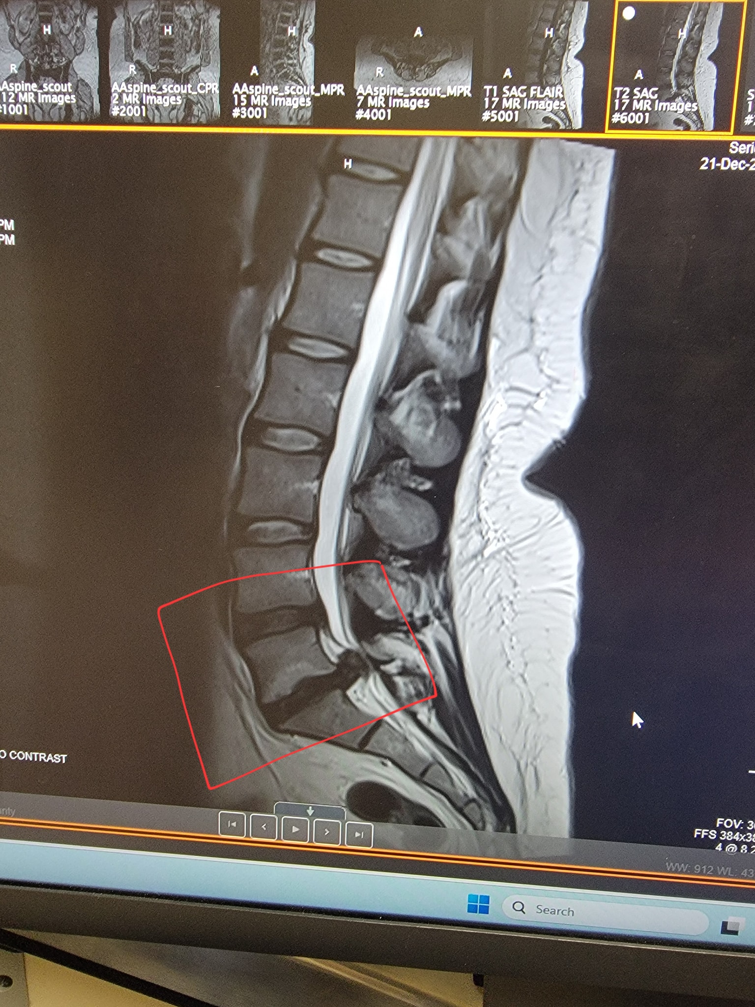 Experiences with disc replacement or fusion after discectomy?