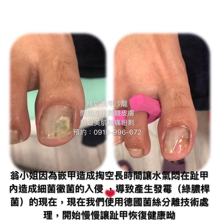 維妮美甲沙龍 指甲掏空 翁小姐因為嵌甲造成 指甲掏空 灰指甲 長時間讓水氣悶在指甲 裡面形成細菌最喜歡的溫床 然後讓細菌黴菌入侵 導致造成 綠膿桿菌 灰指甲 現在我們採用德國 箘絲分離術處理指甲 慢慢的讓指甲恢復健康