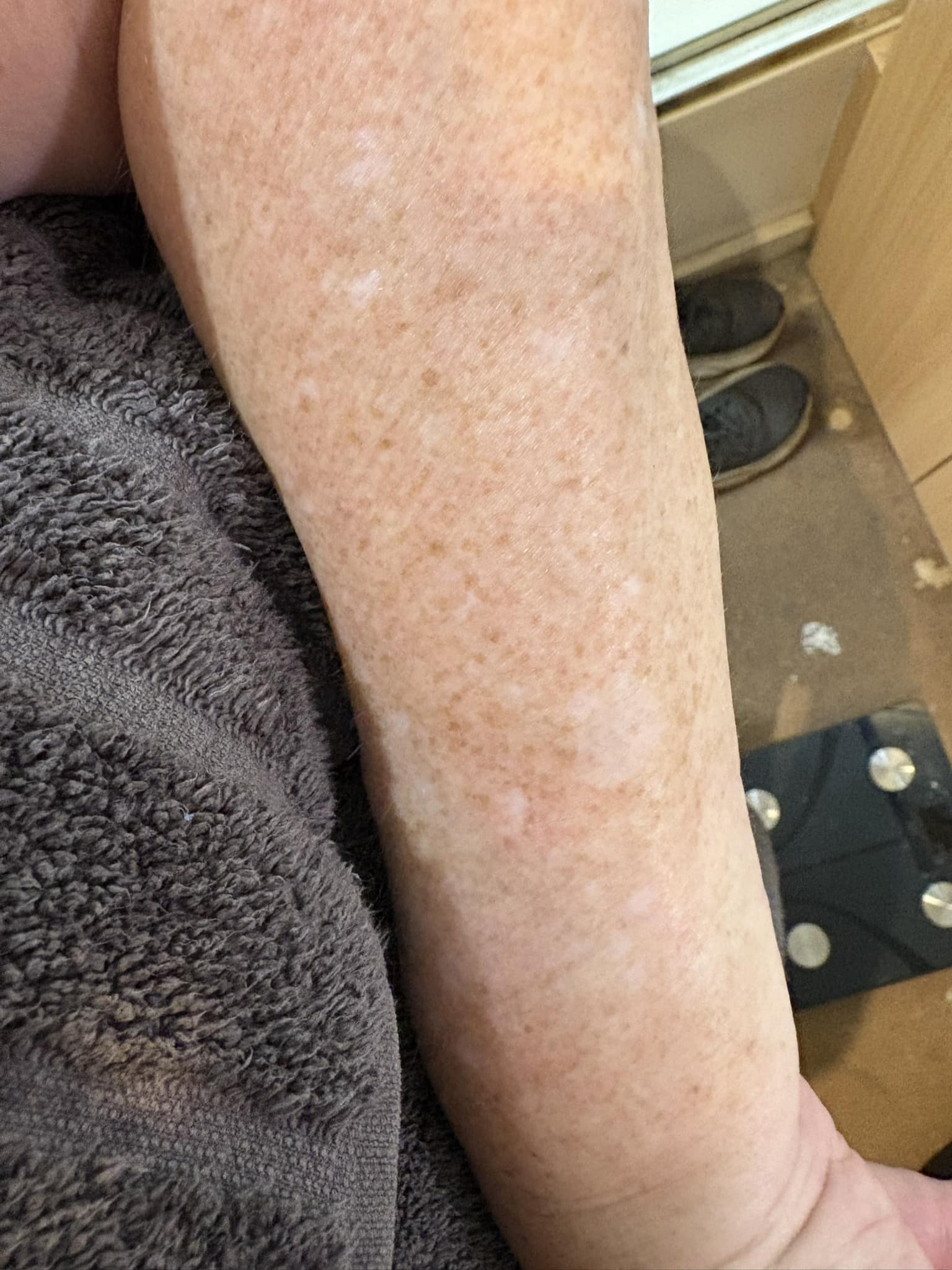 does glutathione cause white spots on skin What are these pale patches skin? how to reconstitute bpc Muscle Support Flavor:Lemon Lime
