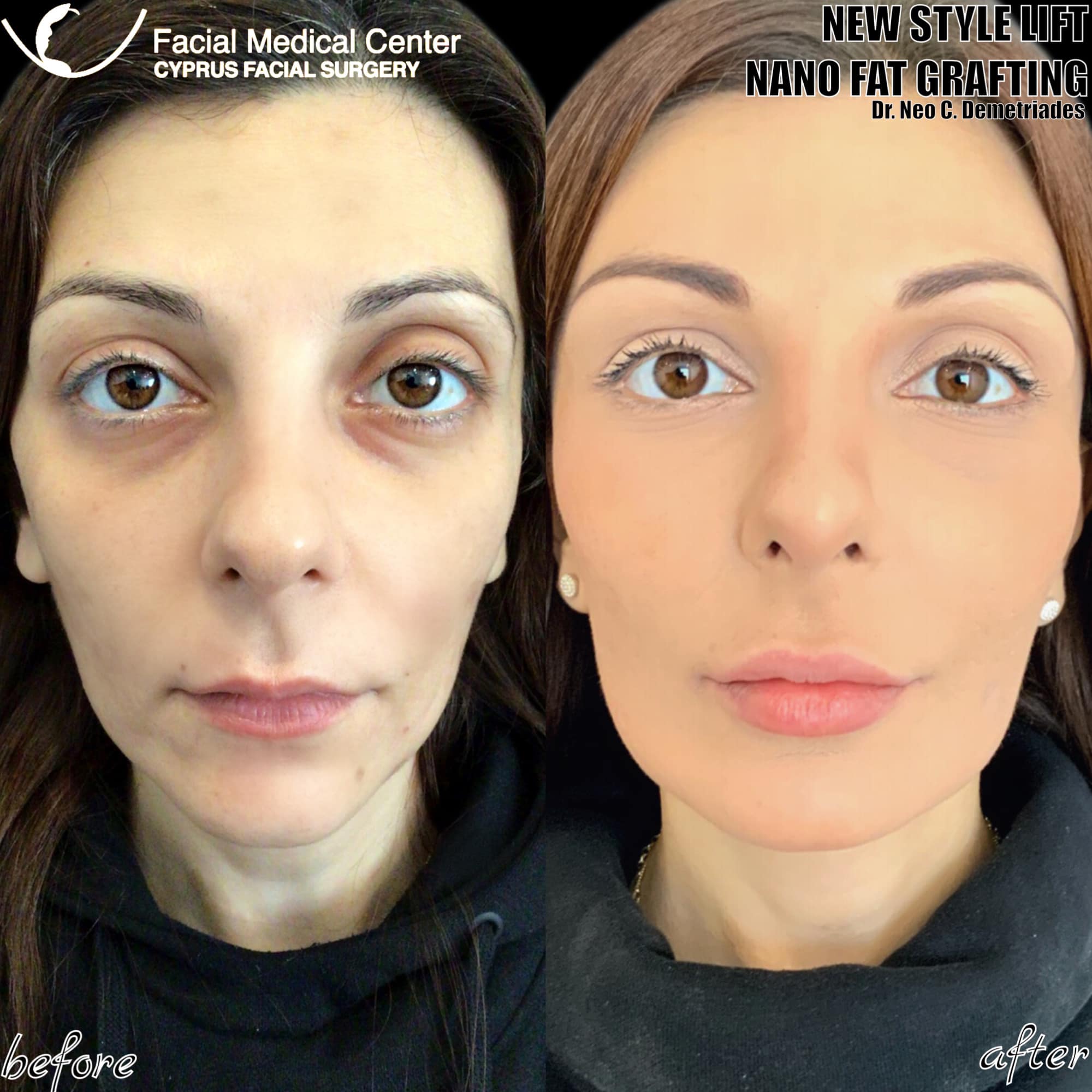 | Our amazing patient with Great... - Cyprus Facial Surgery | Facebook