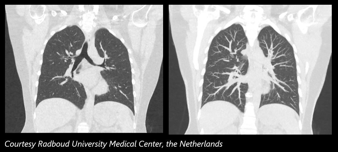 Canon Medical Systems Corporation - Lung cancer is presently the ...