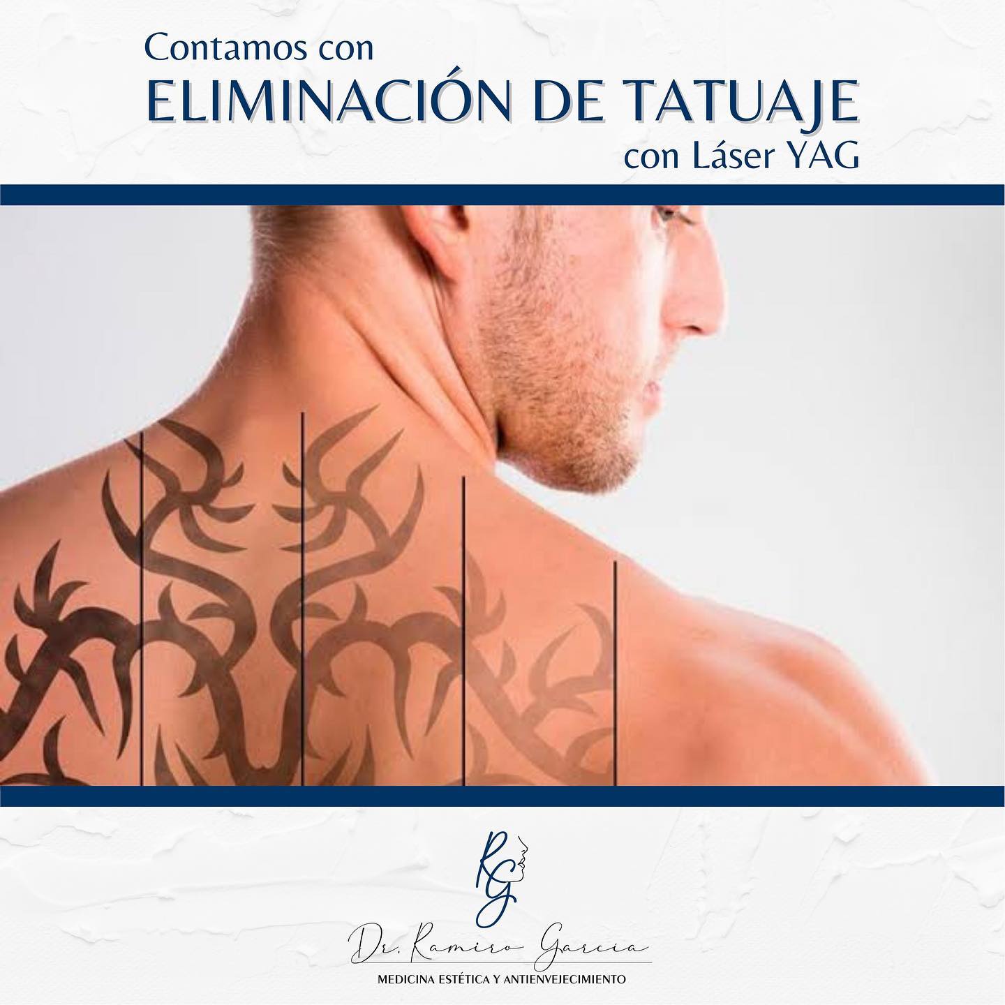 La eliminación de tatuajes mediante... - Dr. Ramiro García | Facebook