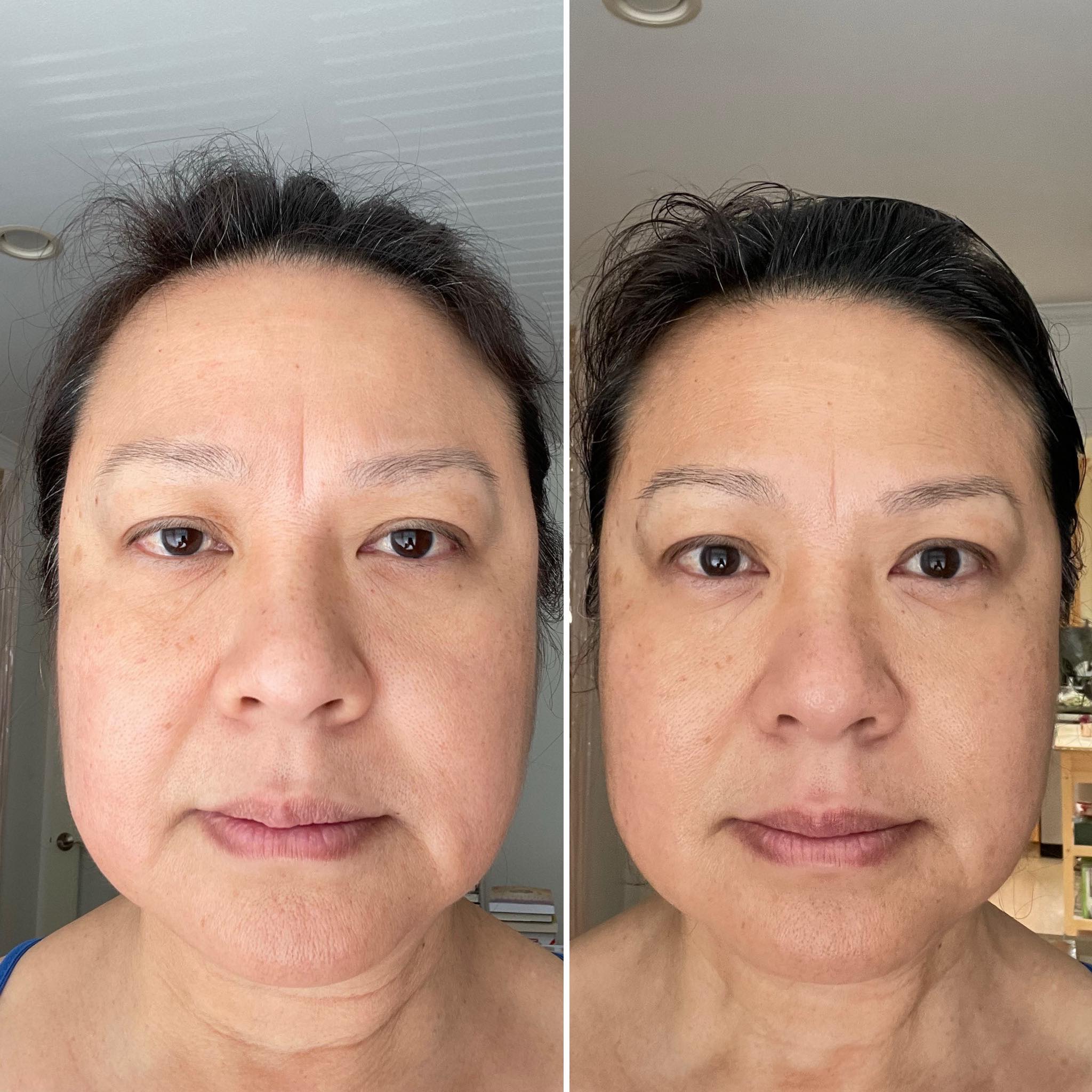 ghk cu wrinkles before and after 12 weeks in, my skin has NEVER looked better! peptides are doing their thing. Alright, I need to give you an update—it's been 12 weeks since I started using GHK Highland Park IV Therapy Treatment Quantity::10 MG