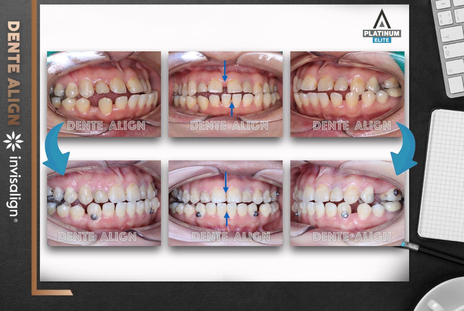 จัดฟันIn... - Dente Align Clinic - Invisalign Diamond Provider | Facebook