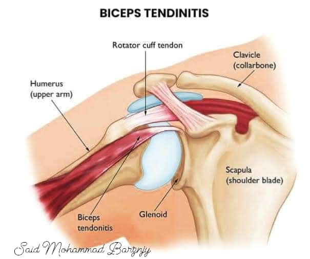 bpc 157 for bicep tendonitis 💥 Fix Your Biceps – Fast Relief! 💪 Dealing with that deep, aching bpc 157 for bicep tendonitis