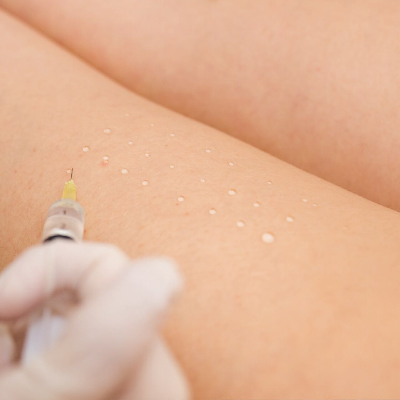 Due Derma - TRATAMIENTOS CON MICROINYECCIONES PARA... | Facebook