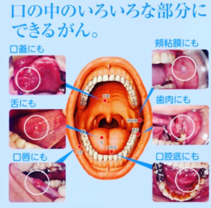 口内炎癌 見分け方 | 口内炎 がん 違い – QBPSBG