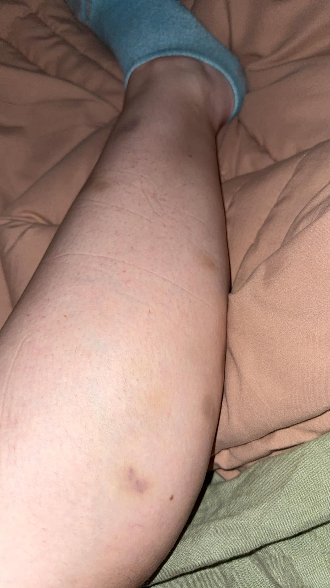 Do blood thinners cause bruising when injected?