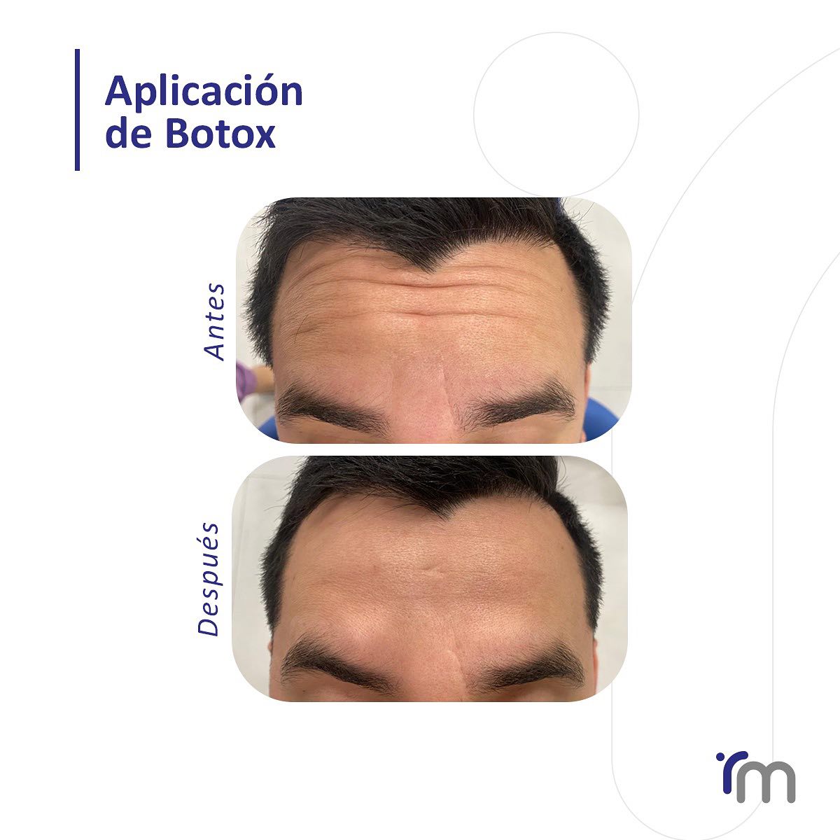 Clínica Roma - El Botox en hombres es un tratamiento con... | Facebook