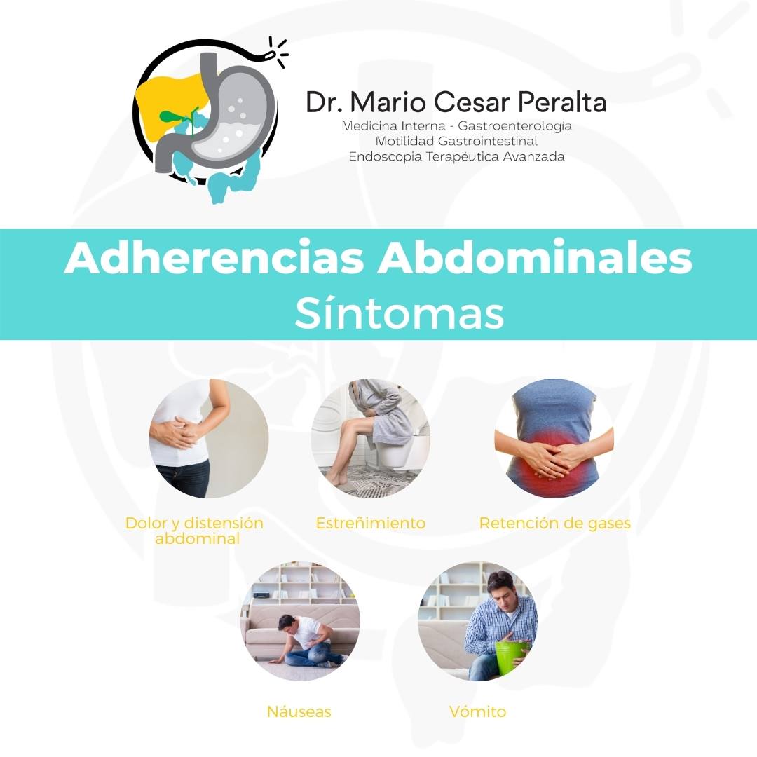 El síntoma más común de la adherencia... - Dr. Mario Peralta | Facebook