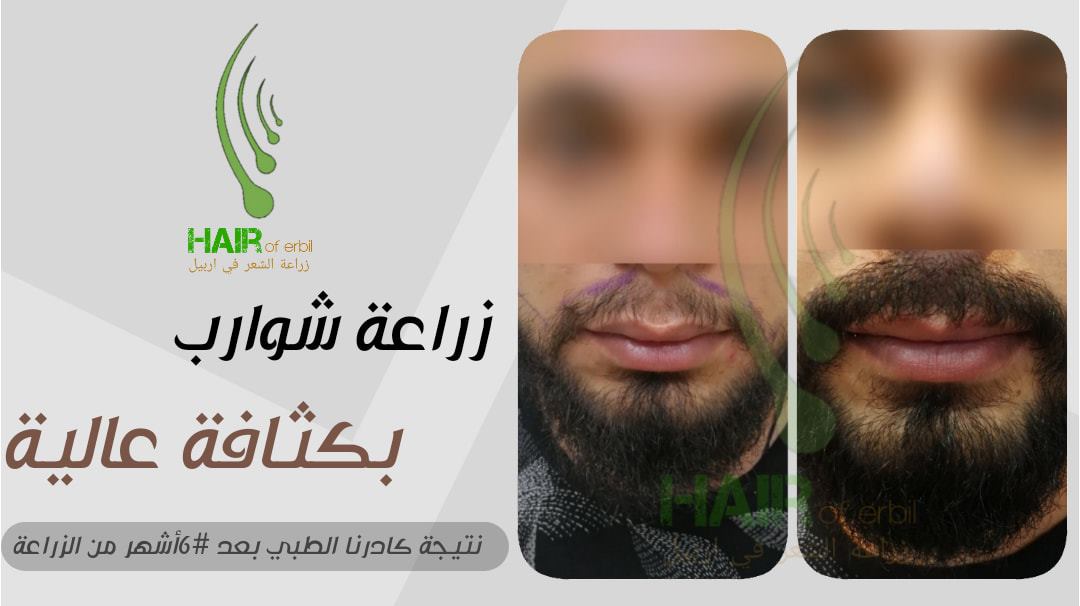 Hair Of Erbil زراعة الشعر في اربيل زراعة الشعر في أربيل نتيجة كادرنا الطبي بعد 6أشهر من زراعة الشوارب يمكنم التواصل عن طريق الصفحة أو عن طريق الواتساب 07730947484 07834877484 للحصول على