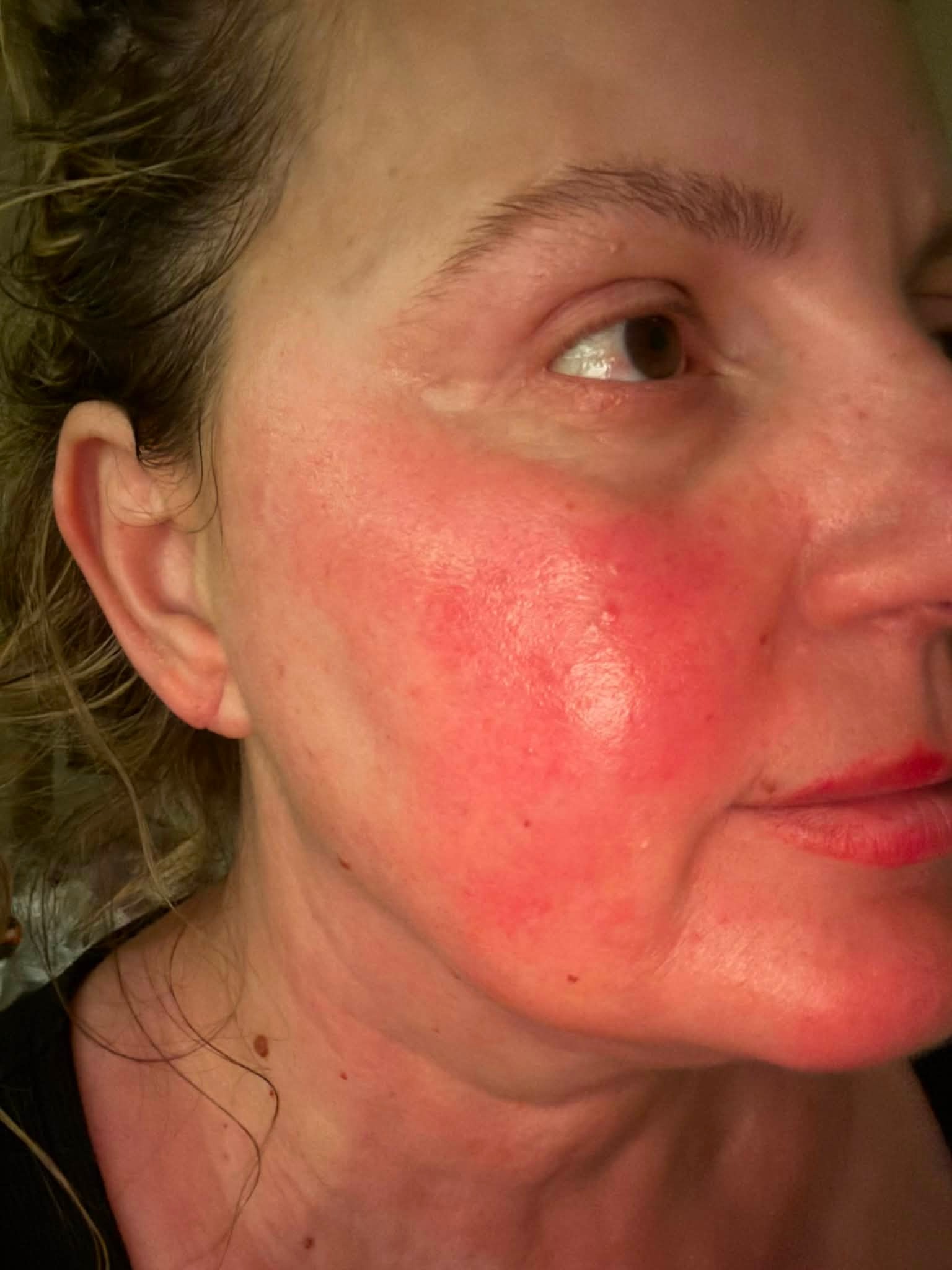 ipamorelin flushing side effects Has cromolyn made worse before improving? Glimmer Goddess Organic Copper Number of Vials:2 Vials (Non-Differentiated Results) l citur