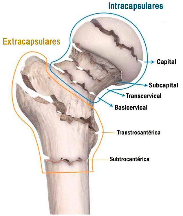 Radiology - This image shows different types of hip fractures ...